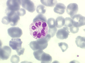 Polynucléaire hypersegmenté